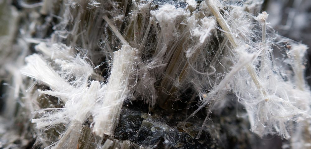 Lungs showing asbestos fibers causing mesothelioma